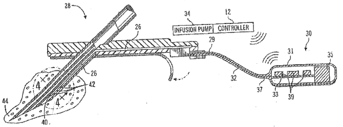 glucose sensor system glucose sensor system