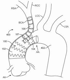Supra Aortic Access Trifurcated Modular Stent Assembly