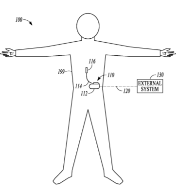 Boston Scientific Files a Patent for a Device for Treating Tissues