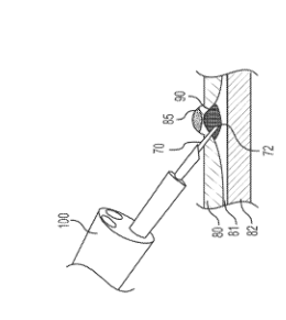 exemplary tissue resection procedure exemplary tissue resection procedure
